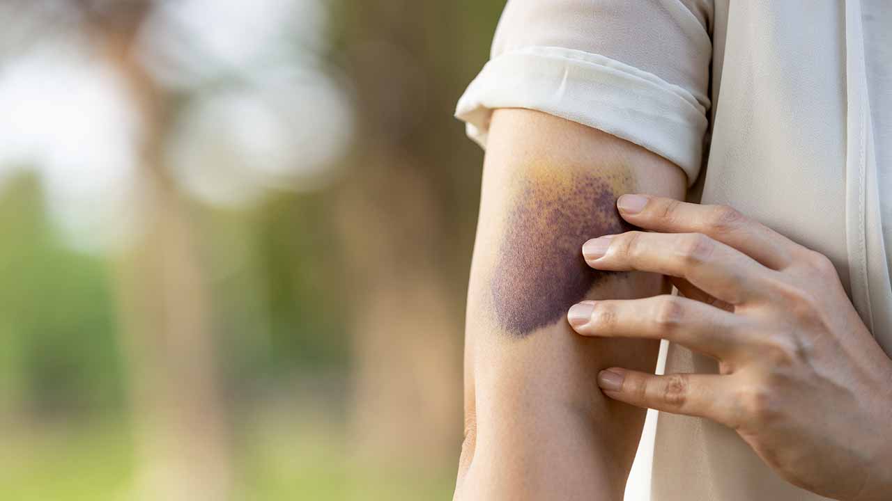Mysterious Bruises, Night Sweats — Is It Blood Cancer? 